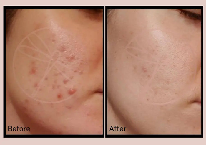 Before & after bravura skincare
