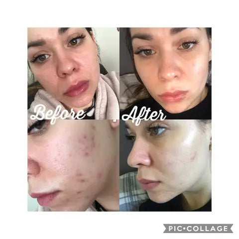 Salicylic Acid 2% Peel 30ml blocked pores and blackhead remover