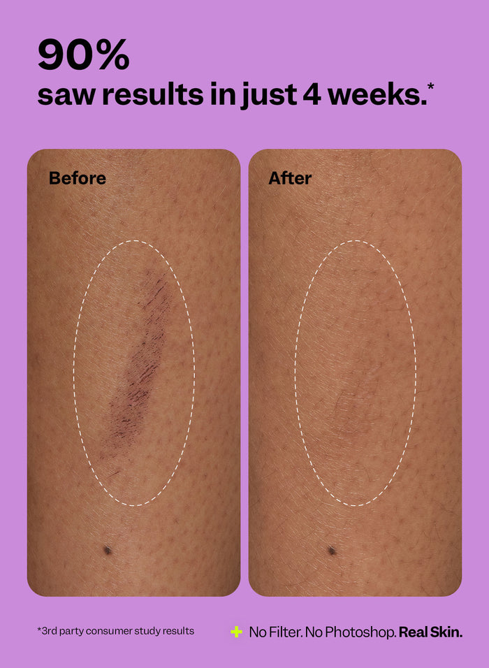 Scar Remedy Silicone Sheets