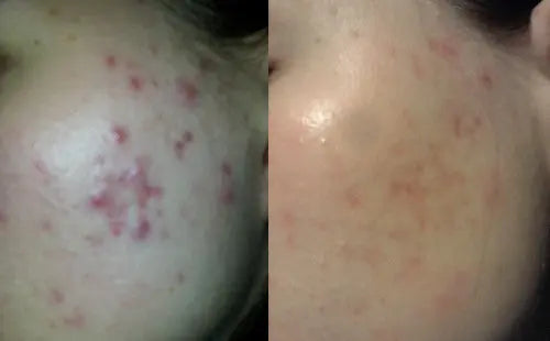 Dermaflannel Facial in a Flannel