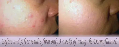 Dermaflannel Facial in a Flannel